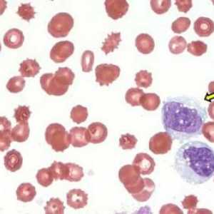 Monocite crescute în sânge - ce înseamnă asta?