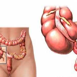 Cauze și simptome ale apendicitei cronice