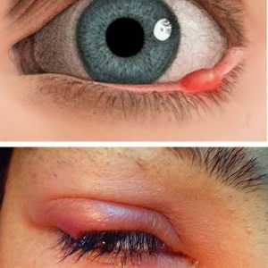 Cauzele apariției, simptomelor și tratamentului orzului la nivelul ochiului la un copil