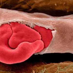 Semne de sângerare capilară din nas