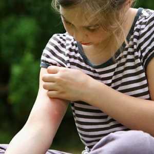 Prevenirea și tratamentul mușcăturilor de țânțari la copii