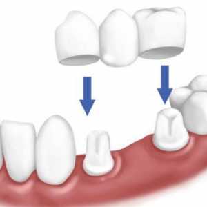 Stomatologie protetică în absența unui număr mare de dinți: specii