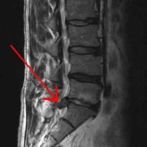 Protruzia coloanei vertebrale lombare. Cum se trateaza proiectia discurilor spinarii?