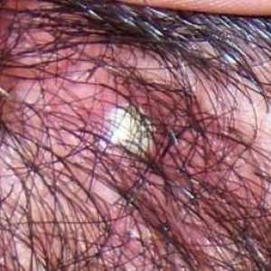 Acnee pe capul de sub păr: cauzele apariției și caracteristicile tratamentului