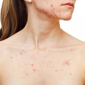 Pimples pe piept: cauze