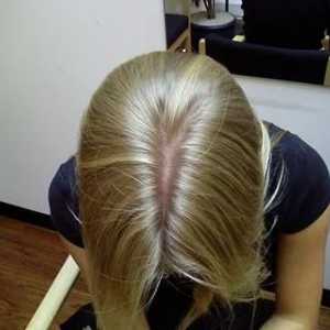 Psoriazisul scalpului: cauze, simptome, tratament
