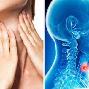 Cancerul de gât: simptome în stadiile incipiente