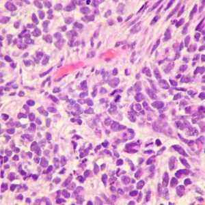 Cancer pulmonar cu celule mici: diagnostic, tratament, prognostic