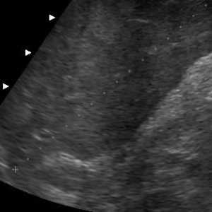 Dimensiunile ficatului sunt normale în ultrasunete (decodare)