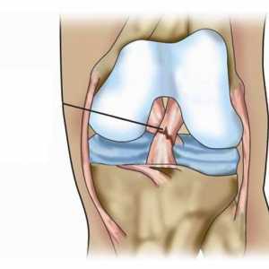 Ruptura ligamentului articulației genunchiului: de ce se întâmplă și cum să o eliminați?
