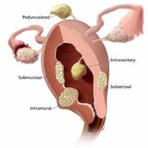 Rupturile uterine: consecințe. Ruptura cervicală în timpul travaliului: consecințe