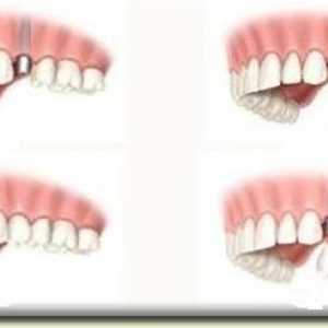 Restaurarea dintelui: când și cum să aplicați procedura?