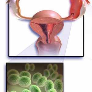 Salpingoophorita este o inflamație a ovarelor