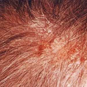Dermatita seboreică la nivelul capului: tratamentul și imaginea clinică