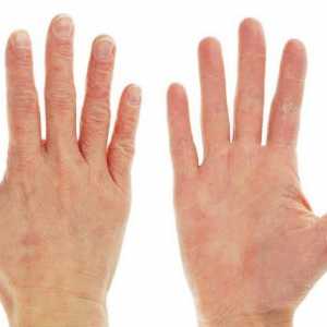 Шелушится кожа на руках: причины и лечение