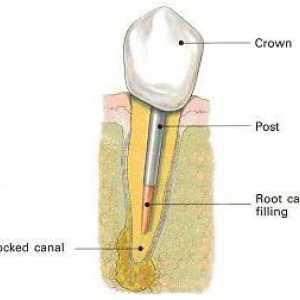 Pini în stomatologie: instalare, recenzii, prețuri