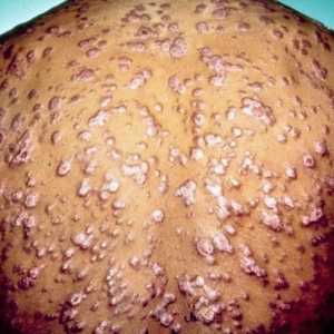 Sifilisul: un simptom al bolii și al tratamentului