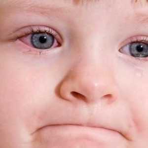 Simptomele și tratamentul conjunctivitei la copii