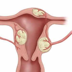 Simptomele și semnele de fibrom uterin: cum se recunoaște boala
