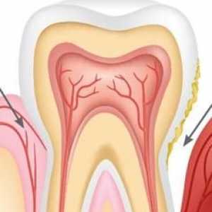 Simptomele parodontitei, diagnosticului și tratamentului