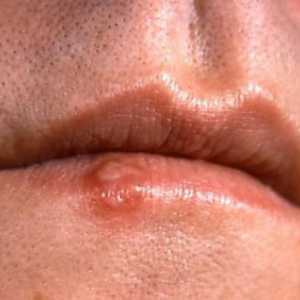 Simptomele cancerului de buze - Cum sa le recunoastem?