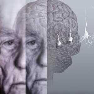 Sindrom de demență sau demență