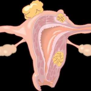 Sindromul epuizării ovariene: cauze, simptome, diagnostic și tratament