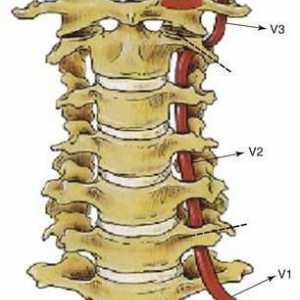 Sindromul arterei vertebrale cu osteocondroză cervicală: simptome și tratament