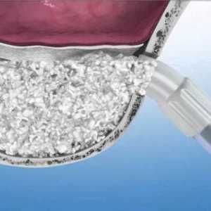 Sinus-lifting: se utilizează pentru implantarea dinților. Tipuri, indicații, posibile complicații