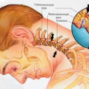 Deplasarea vertebrelor cervicale: simptome, diagnostic și tratament
