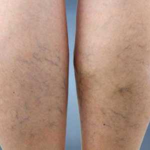 Rețeaua vasculară pe picioare: cum să scapi de, cauzele și caracteristicile tratamentului