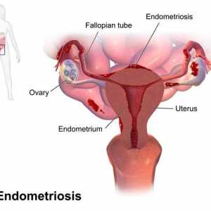 Spirala "Mirena" la o endometrioză: răspunsuri