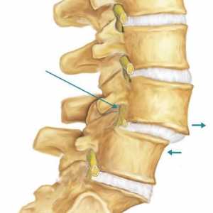 Spondiloza coloanei vertebrale cervicale: cauze, simptome și metode de tratament