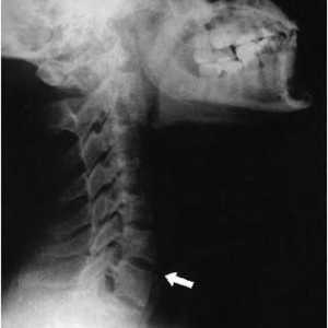 Spondilartroza coloanei vertebrale cervicale: cauze, simptome și metode de tratament
