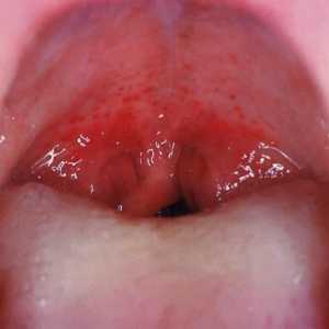 Stafilococul în gât și nas