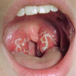 Streptococi în gât: semne, cauze și tratament