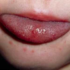 Erupțiile cutanate la nivelul gurii copilului: care sunt bolile care o provoacă?