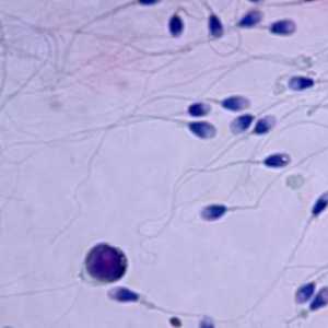 Teratozoospermia - ce este? Principalele cauze ale infertilității masculine