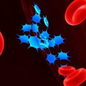 Trombocitopenie - ce este? Cauzele și simptomele bolii