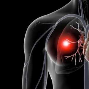 Tromboembolismul arterei pulmonare: cauze, diagnostic, simptome și tratament