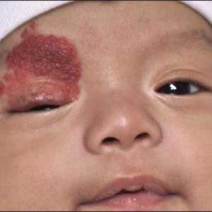 Eliminarea hemangioamelor prin laser la copii și adulți: contraindicații și asistență post-procedură