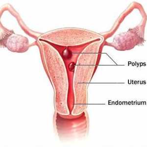 Eliminarea polipului în uter: recenzii. Perioada postoperatorie