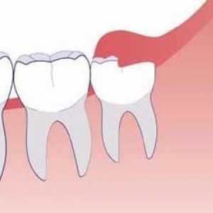 Extracția dinților în înțelepciune pe maxilarul inferior: trăsături, consecințe