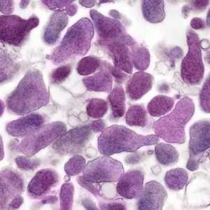 Ureaplasma spp. - Ce este asta? Simptome, tratament și consecințe