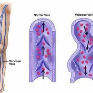 Venotonics pentru picioare varicoase: o descriere a preparatelor