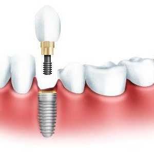 Tipuri de implante dentare: descriere, argumente pro și contra, fotografie