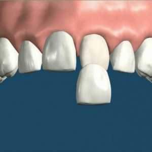 Furnir pe dinți: avantajele elementului, caracteristicile instalării sale și indicațiile de…