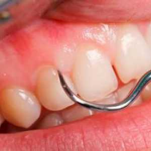 Inflamația gingiei lângă dintele de înțelepciune. Cum de a scuti gingivita la domiciliu