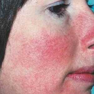 Inflamația pielii pe față: cauze, tipuri, prevenirea și tratamentul