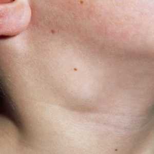Inflamația ganglionilor limfatici în gât la un copil: cauze și tratament